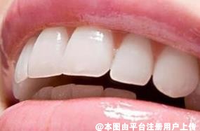 一喝冷的酸的就牙疼 这可能是你牙齿开裂了