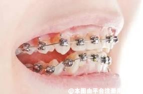 牙齿矫正基本分为四个阶段 不能过于急着矫正好-26680