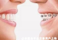 并非所有人都能矫正牙齿 哪些人不适合