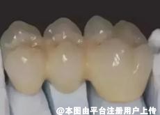 做过烤瓷牙还能做牙齿矫正吗 可以从这三个方面来考虑