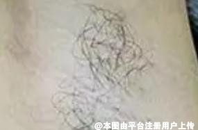 这个夏天你准备用什么方法脱毛呢