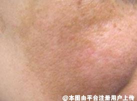 解答皮肤激光后的色沉问题是怎么回事