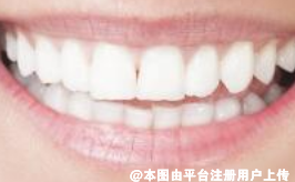 牙齿要白白的才好看