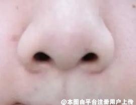 4大常见不理想鼻型该如何改善呢