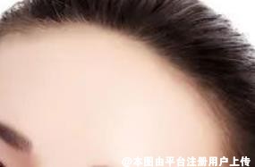 额头宽大 给面部带来影响也不小