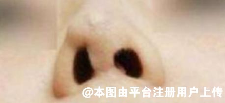 为什么有些人在隆鼻后会出现鼻翼不对称-26870