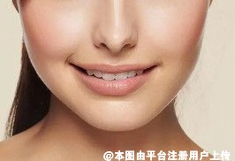 为什么有些人做了丰苹果肌后笑起来却很不自然