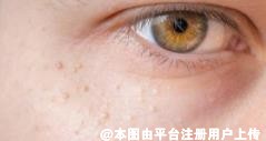 为什么会长脂肪粒 可以挑掉吗