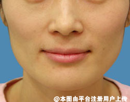 姐妹们 做面部脂肪填充要注意这几点