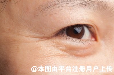 鱼尾纹让颜值大打折扣 祛除鱼尾纹小妙招你值得拥有