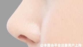 哪些求美者适合进行肋软骨隆鼻手术 快来看看吧