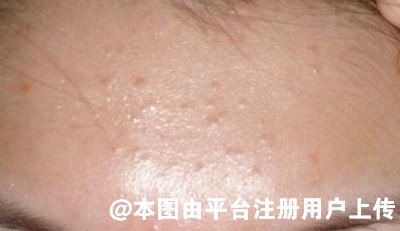 脸上长白头粉刺是什么原因？日常去粉刺可以用这些方法