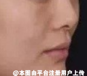 自体脂肪丰苹果肌多久自然呢