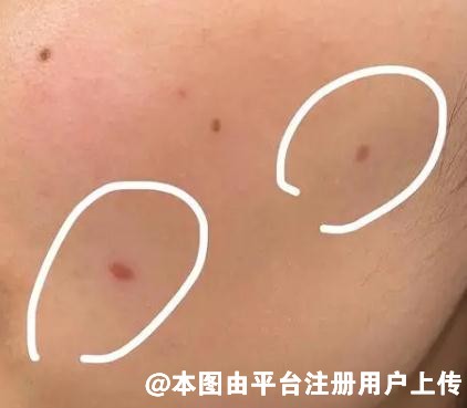 脸上有痣怎么去掉 激光祛痣好吗