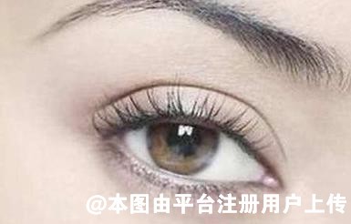 割双眼皮很久了 为什么还是会被别人一眼就看出来-27800