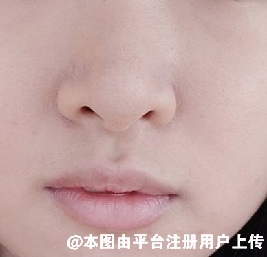 鼻孔外翻很难看 能不能做鼻翼缩小改善呢