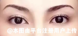 做完双眼皮后在恢复的阶段中该如何护理-28043