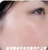 让自己拥有更佳的肌肤状态 光子嫩肤是个不错的选择