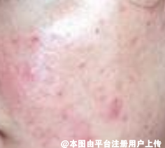 脸上爆痘怎么办 来试试点阵激光