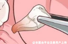 拔牙后该如何让牙龈伤口快速愈合 可以试试这样去做-28109