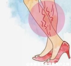 静脉曲张无法自我修复 它有这些危害