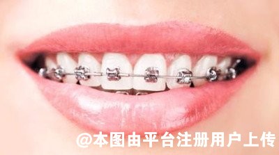 牙齿矫正真的可以让脸型变好看吗 这四种牙齿可以