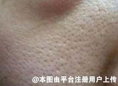 毛孔粗大怎么办 教你如何护肤