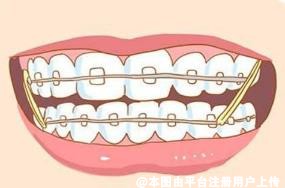 关于牙齿矫正问题 这里都有快来看看吧