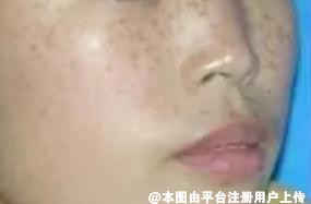脸部的斑是女性的天敌 如何才能消除脸部的斑呢-28448