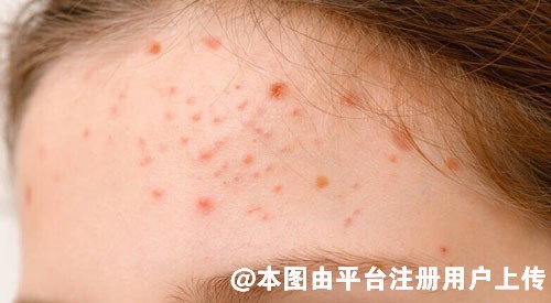 花式压力之下的上班族 皮肤容易出现这些问题-28476