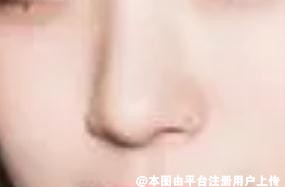 人老了 做的隆鼻假体需要取出来吗