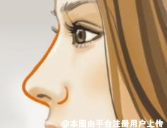 超肋隆鼻怎么样 在不同隆鼻材料里有什么优势-28618