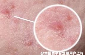 想要预防长痘 平时养成好的饮食作息等生活习惯