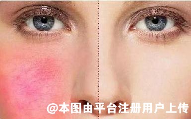 避免白做 光子嫩肤后需要注意这几点-28698