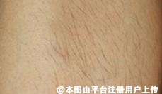 用激光脱毛后会不会导致毛孔变大-28831