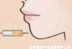 短的下巴需要打多少支玻尿酸填充？