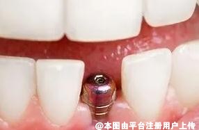 在日常生活中积极预防牙周炎是非常有必要的