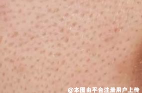 毛孔粗大很难看 找对方法能改善-29311