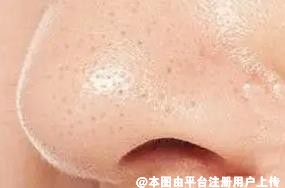 想要有效地攻克黑头 可以试试这个方法-29378
