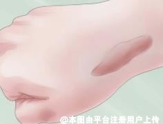 疤痕的修复期是多长  这两点是修复时间的决定因素-29384