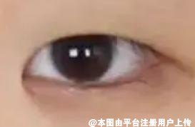 好看的双眼皮总是比较吸引人  哪些情况不适合做双眼皮呢