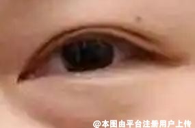 不同的年龄 祛眼袋的方法也是不同的