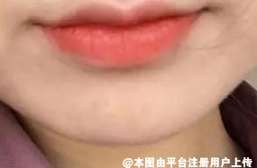 下巴比较短该怎么办 假体隆下巴可以维持多久呢