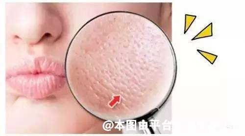毛孔太大怎么办 这些毛孔堵塞的清理方法赶紧用起来