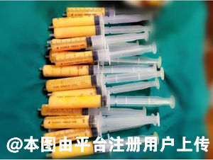 做面部脂肪填充后发硬有硬块是因为脂肪没有成活吗