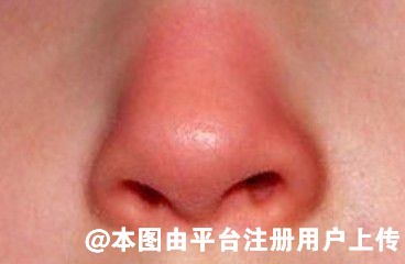 隆鼻后鼻子一直红肿是什么情况 改如何应对