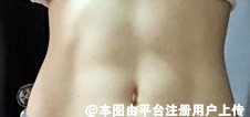 哪些人适合做吸脂 之后会不会出现皮肤松弛