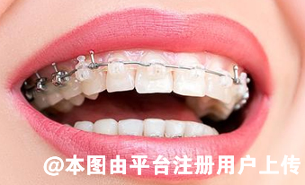 牙齿畸形如何矫正 牙齿矫正有年龄规定吗