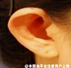 招风耳招财？这叫耳廓畸形，可以通过耳整形矫正