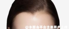 美人尖植发和发际线植发的区别就在于2点